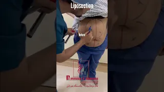 liposuction | body contouring | Dr Mudassir Mahboob-Plastic Surgeon