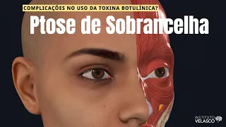 Entendendo a Ptose de Sobrancelha! Complicações no uso da Toxina Botulínica [Harmonização Facial]