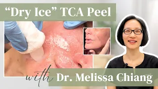 Medium-Depth Chemical Peel - Dry Ice & TCA 35% with Board-Certified Dermatologist Dr. Melissa Chiang