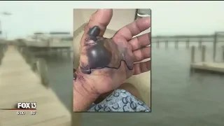 Flesh-eating bacteria nearly kills Florida fisherman