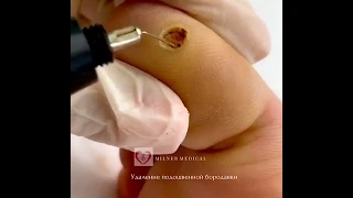 Удаление бородавки на ноге методом РВХ в Мильнер Медикал Харьков
