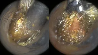 104 - Large Ear Wax Lump Removal in Young Boy using the WAXscope®️