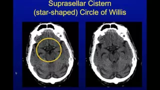 Head CT Interpretation Made Easy