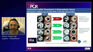 Challenges and opportunities in high-risk patients undergoing TAVI - EuroPCR 2021