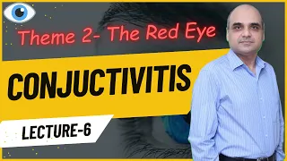 Conjunctivitis Lecture 6