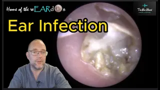 Ear Infection - Episode 143 #ear #earwax #earwaxremoval #earcleaning #earwaxclinic #earwaxextraction