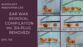 EAR WAX REMOVAL COMPILATION INCLUDING 3/4 INCH PLUG REMOVED - EP 150