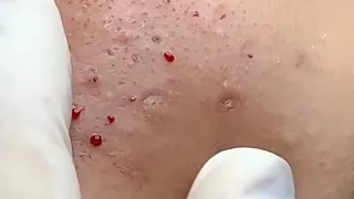 Blackheads Removal# 194