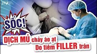 SỐC! DỊCH MỦ CHẢY ÀO ẠT trên trán người phụ nữ do TIÊM FILLER