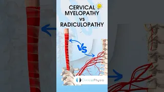 Cervical Radiculopathy vs Myelopathy #physiotherapy #physicaltherapy #medical