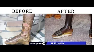 LEG CANCER VANISHES IMMEDIATELY!!  P.I.A OBASEKI MINISTRIES