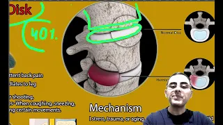 Herniated Disk Symptoms, causes and treatment. Sciatica is Herniated disk?