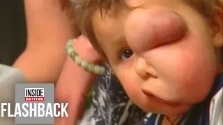 How Toddler’s Life Was Saved by Having Facial Tumor Removed