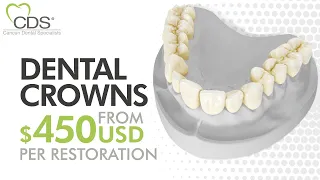 Dental Crowns in Mexico: Get To Know the Procedure! | Cancun Dental Specialists