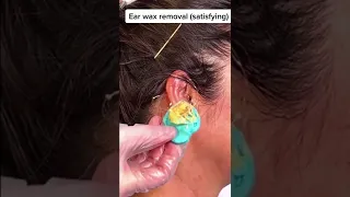 EAR WAX REMOVAL