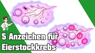 5 Frühwarnzeichen von Eierstockkrebs, die Frauen niemals ignorieren sollten ❌