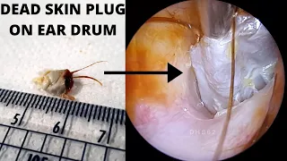 The Ultimate Ear Drum Skin Peel (Keratin plug Extraction)