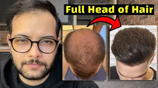 The ONLY Hair loss Treatment that can do THIS !! ( Verteporfin update )