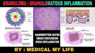 GRANULOMA | GRANULOMATOUS INFLAMMATION | Types Of Chronic Inflammation