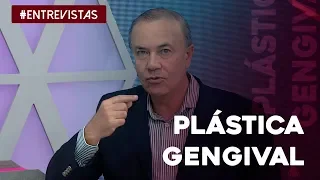 Tudo o que você precisa saber sobre plástica gengival