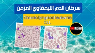 سرطان الدم الليمفاوي المزمن 🔥 chronic lymphocytic leukemia 💔 CLL