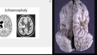 Schizencephaly presentation