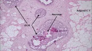 TBIO 572 breast cancer lab part 2