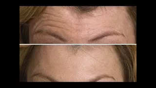 Face Exercise to Lift & Tighten Your Forehead | FACEROBICS®