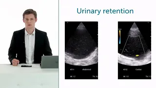 What Do Urinary Stones in the Bladder Look Like?