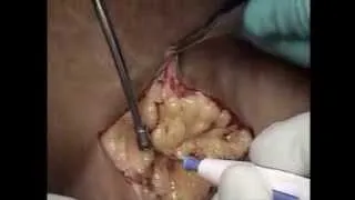 Arteriovenous Fistula Surgeon: Patrick C. Ryan, MD