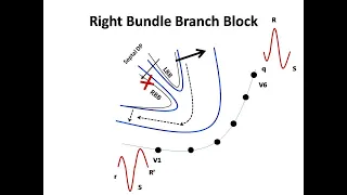 ECG course: Bundle Branch Blocks, Dr. Sherif Altoukhy