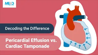 Decoding the Difference: Pericardial Effusion vs. Cardiac Tamponade