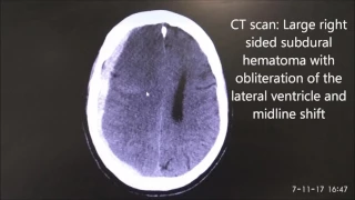 Ocular ultrasound for raised Intracranial Pressure