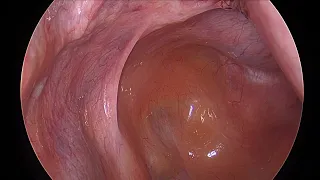 Large Fibroid Uterus - Total Laparoscopic Hysterectomy with Bilateral Sapling Oophorectomy