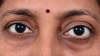 Transconjunctival Orbitotomy: Tips and Tricks: Dr Santosh G. Honavar