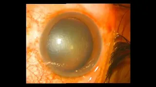 Eyeworm Removal