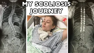 MY SCOLIOSIS STORY | FUSION SURGERY AND RECOVERY UK | STORY TIME