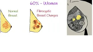 Fibrocystic breast- Causes, Symptoms and Treatment.  Fibrocystic Breast Disease;