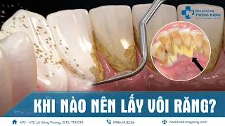 Khi nào nên lấy vôi răng? Giải đáp từ các chuyên gia Nha Khoa Trồng Răng Sài Gòn ®