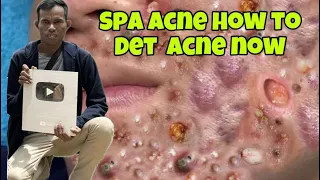 Thank You For Being More ThanJust A Dort Or#acne