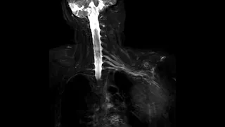 brachial plexus MRI with 3D CUBE STIR on GE HDXt