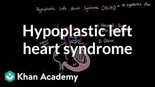 Hypoplastic left heart syndrome and norwood glenn fontan | NCLEX-RN | Khan Academy