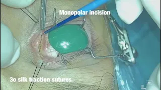 Transcaruncular incison to medial orbit