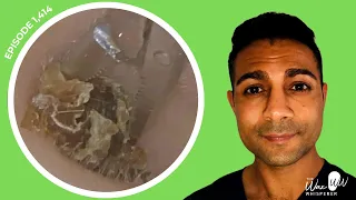 1,414 - Extreme Pruritus Dead Skin Keratin Removal | Read BSHAA Reply