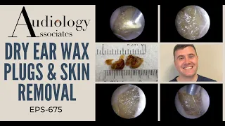 DRY EAR WAX PLUG & SKIN REMOVAL - EP675