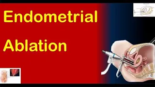 Endometrial Ablation: Types, Procedure, Recovery, & Complications