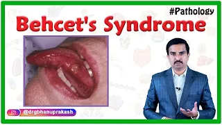 Behcet's syndrome/Behcet Disease - Etiology, Pathogenesis, Clinical features, Diagnosis, & Treatment