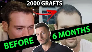 Connor Murphy 6 Months after his Hair Transplant (2000 Grafts FUE)! My Thoughts