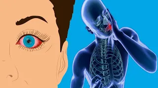 Arthritis Affects The Eyes: How?