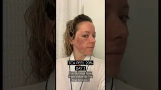 20% TCA PEEL DAY 3 - SUN DAMAGE IS NOW MORE VISIBLE BECAUSE THE PEEL ATTACKS IT